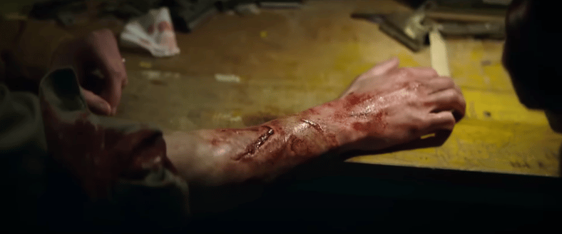 Scars