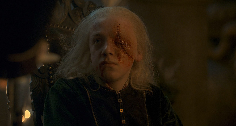 Aemond Targaryen loses an eye in House of the Dragon, HBO